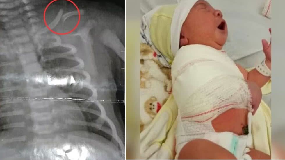 Bebê tem clavícula fraturada durante parto e mãe é denunciada ao Conselho Tutelar; entenda - Imagem: Reprodução | Acervo g1
