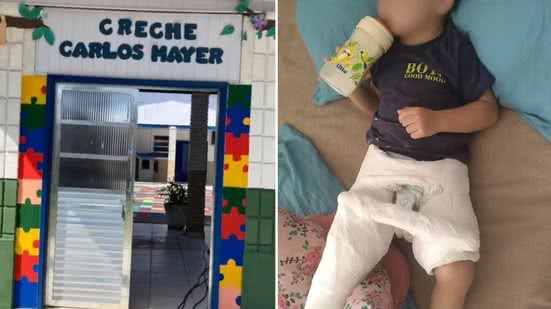 Menino de 2 anos sofre grave acidente em creche no litoral de São Paulo - Imagem: Reprodução/ g1