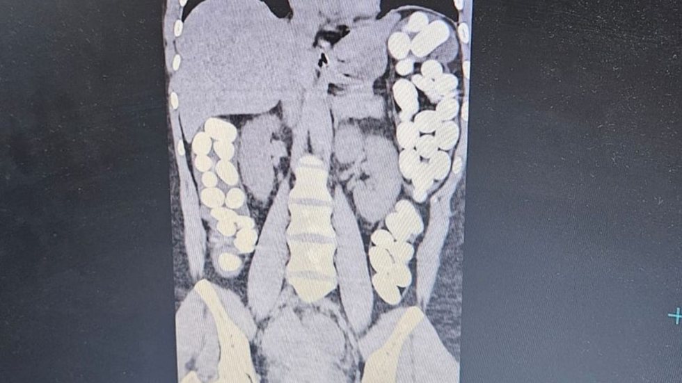 Exames de imagem revelaram a presença de mais de 30 cápsulas de drogas no intestino grosso da paciente - Imagem: Reprodução/Redes Sociais